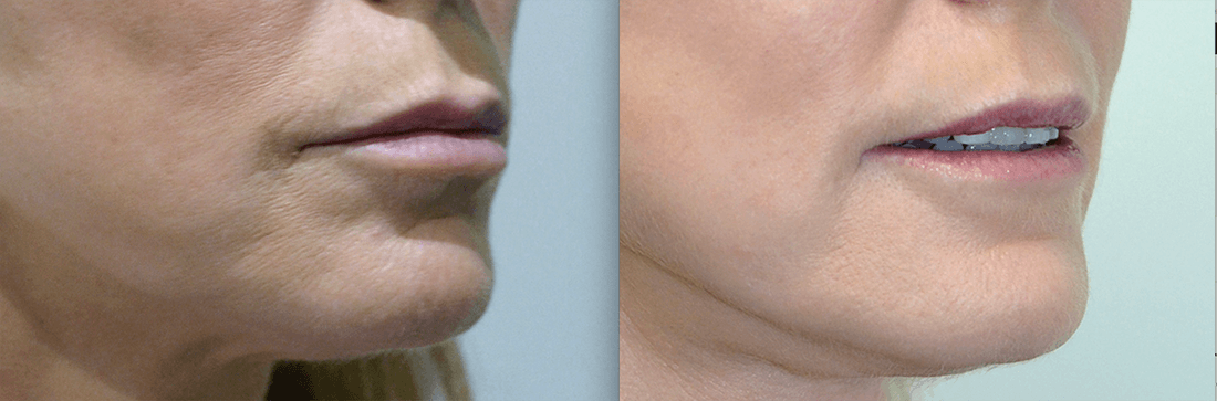 Signature laser resurfacing before and after
