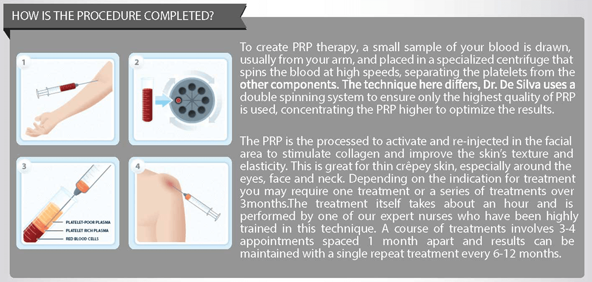 How is the PRP therapy completed article