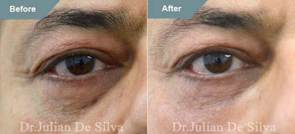 Fillers to treat under eye bags before and after