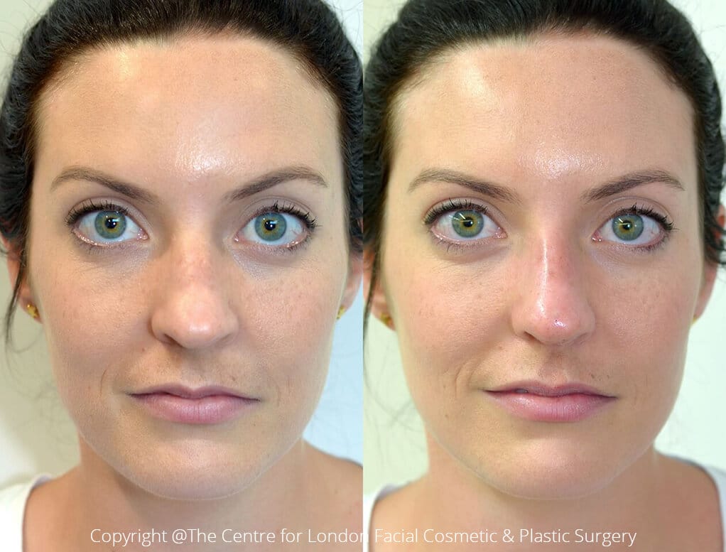 Non-surgical Rhinoplasty before and after