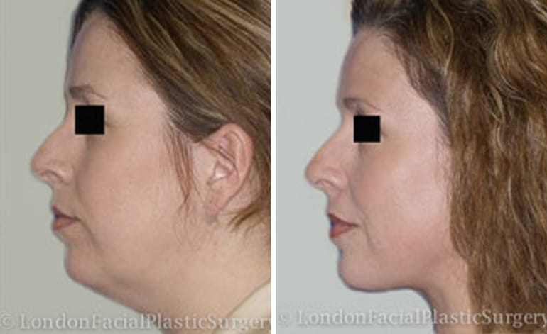 Non-surgical facelift before and after