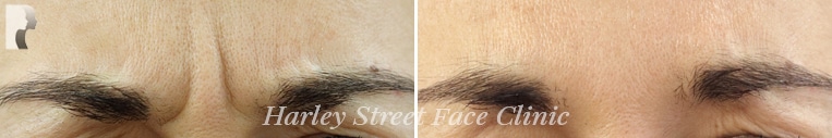 Forehead botox treatment before and after