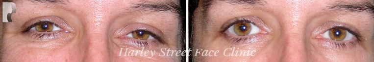 Botox treatment before and after