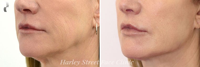 Non-surgical treatments Jaw before and after photo