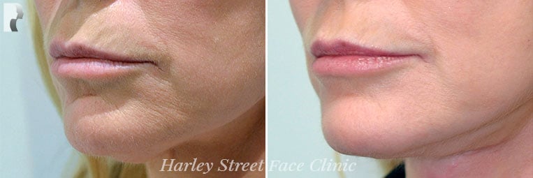 Non-surgical treatments Jawline before and after photo
