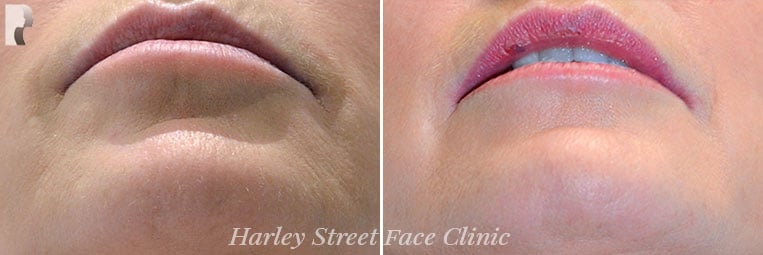 Laser Non-surgical treatments before and after photo