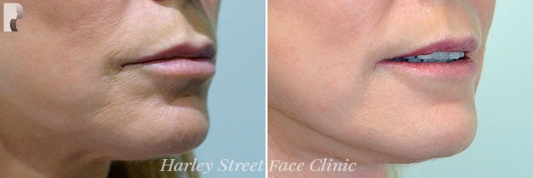 Non-surgical Laser treatments before and after photo