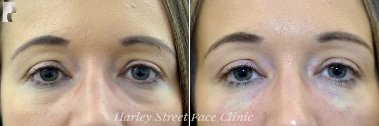 Non-surgical treatments before and after photo