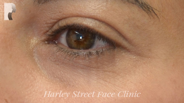 Non-surgical treatment of wrinkles under the eyes