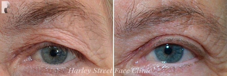 Skin Rejuvenation before and after photo