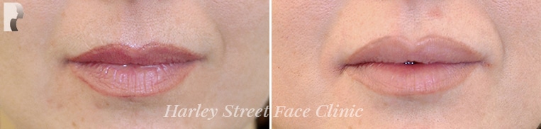 Non-surgical treatments lip before and after photo