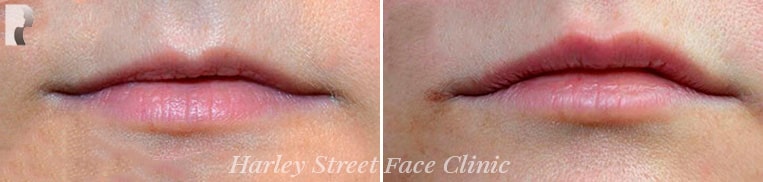 Non-surgical treatments lip before and after photo