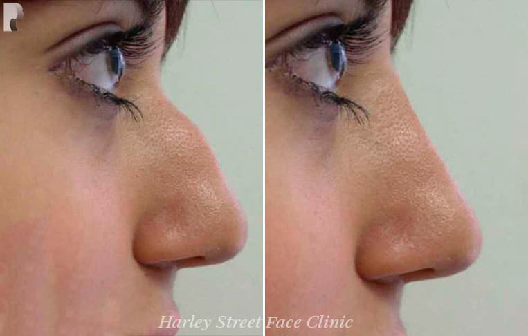 Non-surgical Nose job before and after photo
