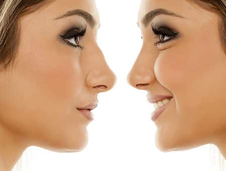 before and after non surgical rhinoplasty