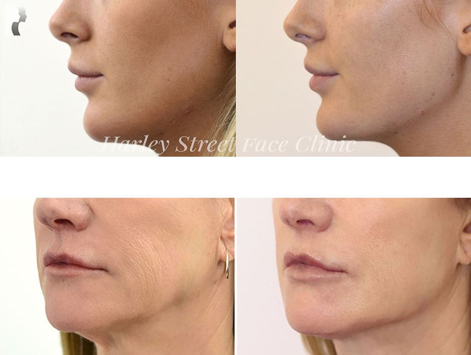 Jawline Contouring Harley Street