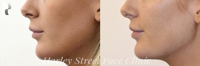 Female chin, before and after Chin and Jawline Fillers treatment, side view patient 1