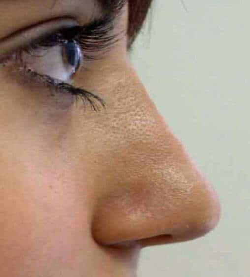 Female nose, after Lunchtime Nose Job treatment, side view patient 1