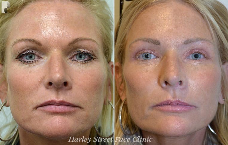 Non Surgical Face Lift before and after photo