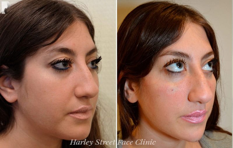 the-best-non-surgical-face-lift-options