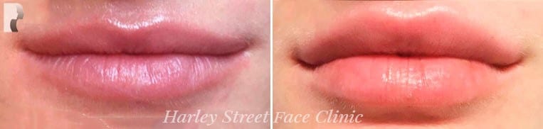 Lip Fillers before and after