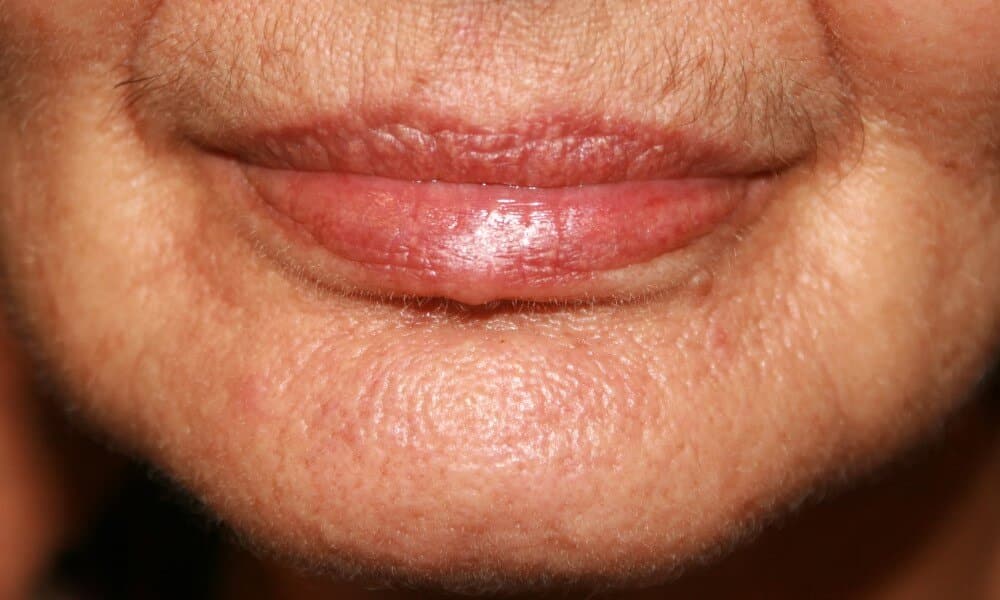 Vertical creases and folds can be eliminated through non-surgical treatments.