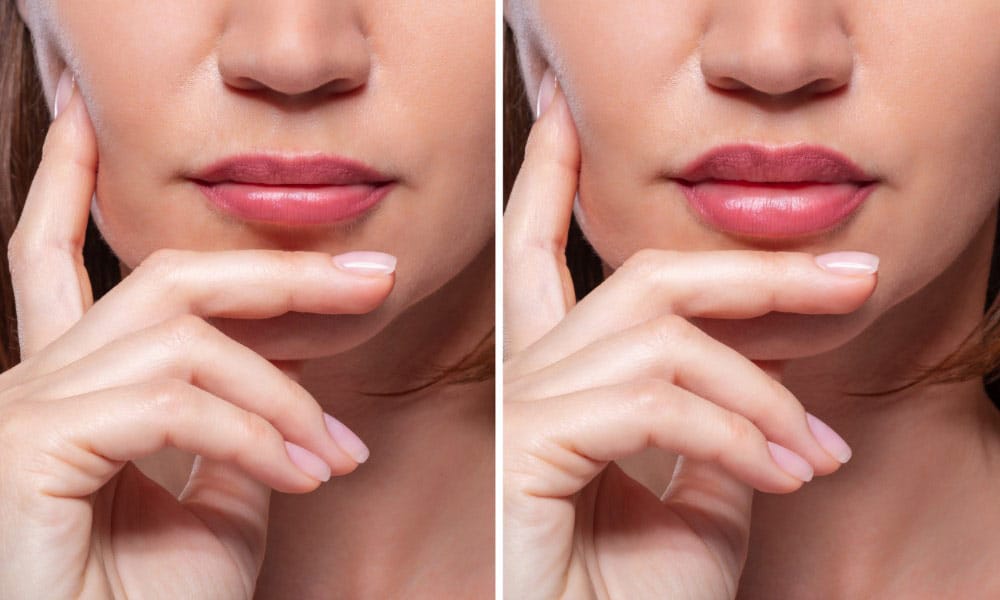 One of the most common causes of lip thinning is a lack of collagen.