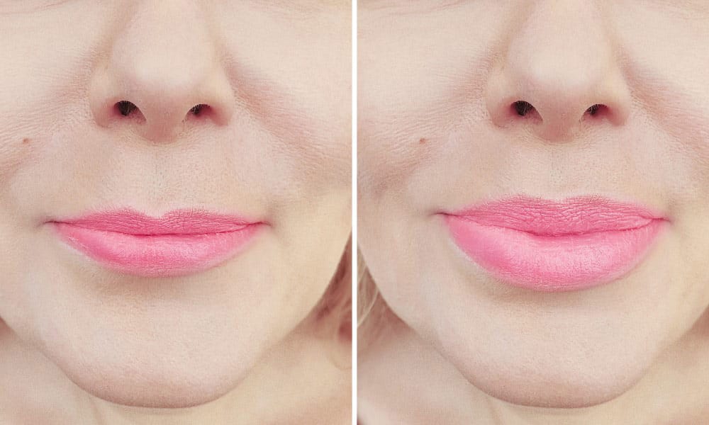 A patient taking a consultation that involves a medical history can get rid of thin lips.