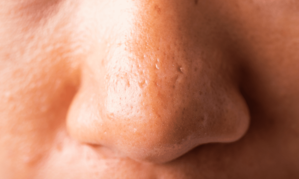 Pores are small openings on the outer layer of the skin that release sweat and oil from our bodies.
