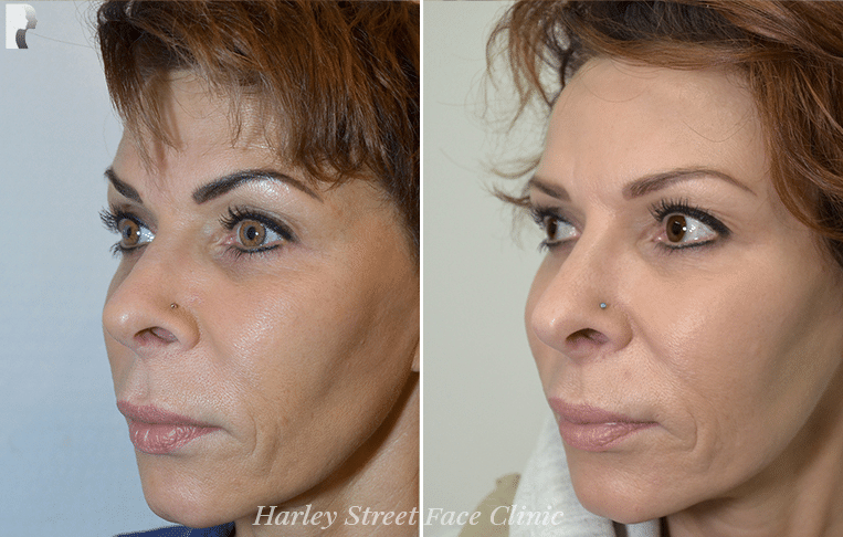 There is a wide range of non-surgical treatment options that address marionette lines effectively.