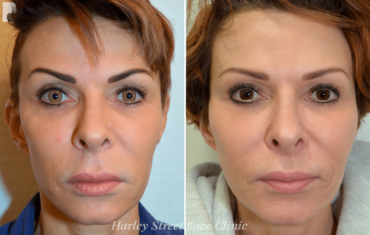 There are minor reactions to injectable fillers for all types, including dermal and Botox in London.