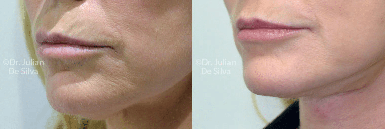 Lip wrinkles are fine lines in the upper and lower lip area caused by several factors, such as ageing, sun exposure, and smoking habits.