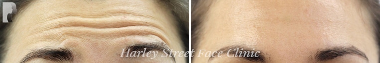 The patient wanted to enhance the appearance of her forehead by addressing her wrinkles, which made her look tired and gaunt.