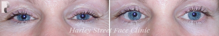 The patient wanted to get rid of wrinkles around her eyes because they make her look old and tired.