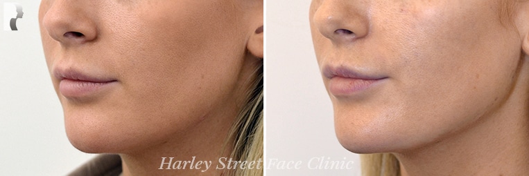 Yes, fillers can eliminate mild and moderate jowls without falling under the knife.