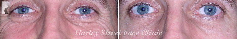 A before and after photo of a patient who had Botox injections with Dr. Julian De Silva. 