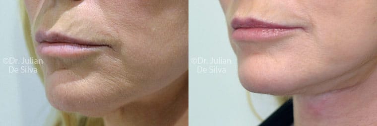 Skin needling and Dermapen are not exactly the same, but they are related.