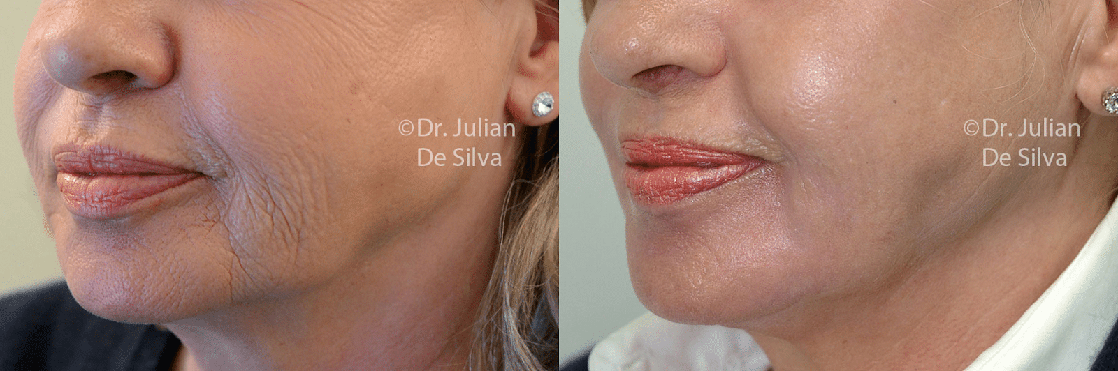 Dermapen and micro-needling are both effective skin rejuvenation treatments.