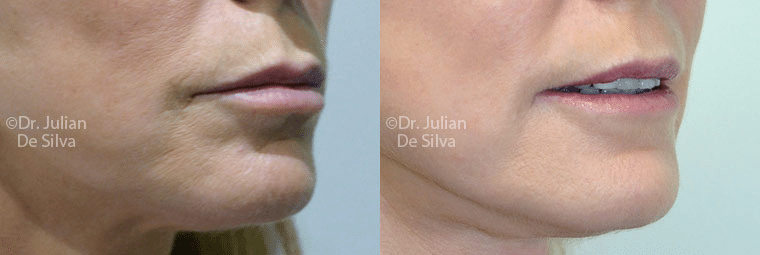 The Dermapen micro-needling treatment can help with many skin concerns.