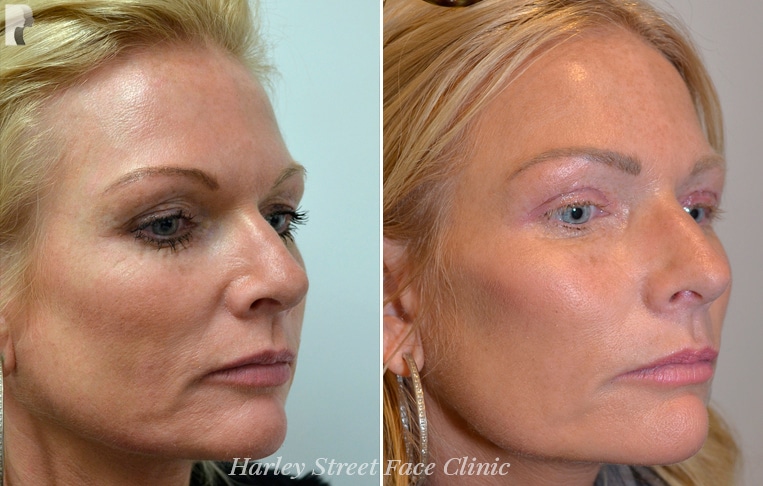 A PDO treatment can also help reduce fine lines and wrinkles.