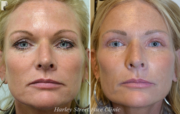 PDO threads, like silhouette soft threads, are a great alternative to facelift surgery.