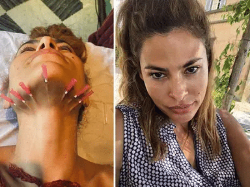 Actress Eva Mendes has been candid about her experience with cosmetic procedures, including a PDO thread lift.