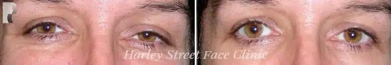 A before and after photo of a patient who had Botox injections with Dr. Julian De Silva. 