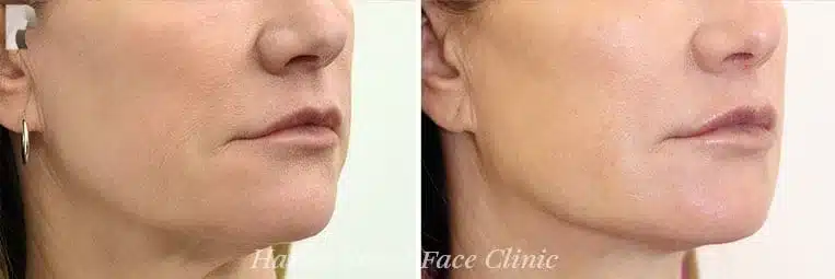 Knowing the severity of your jowls allows you to get the right treatment and optimal results.