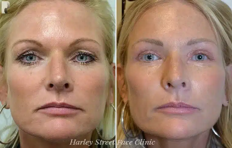 A patient who had a non-surgical treatment done by Dr. Julian De Silva in London. 