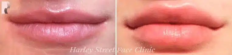 Swelling after lip fillers is your body's normal response to the injections.